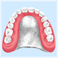 金属床入れ歯【自費診療】