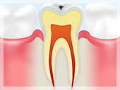 C0【ごく初期のむし歯】