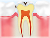 C1【エナメル質のむし歯】
