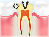 C2【象牙質のむし歯】
