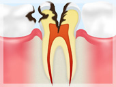 C3【神経まで達したむし歯】