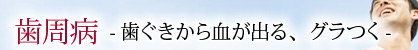 歯周病 -歯ぐきから血が出る、グラつく-